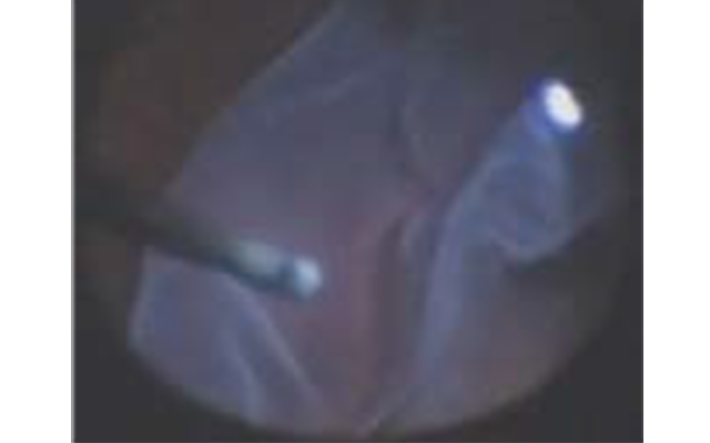 Ablacija Retine sa gigantskom rupturom Retine