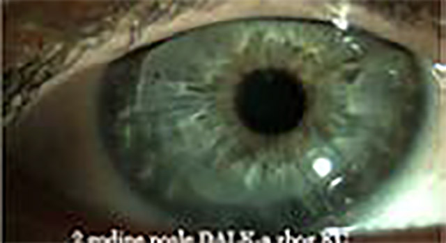 DALK posle skidanja konaca