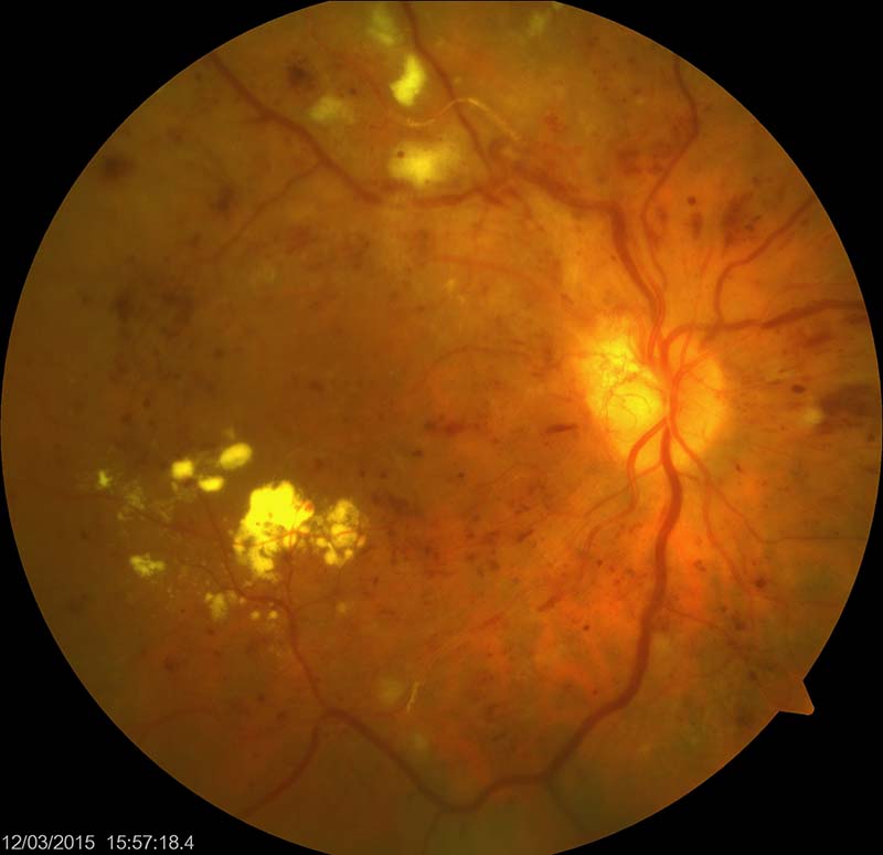 Dijabetes komplikacije ocno dno