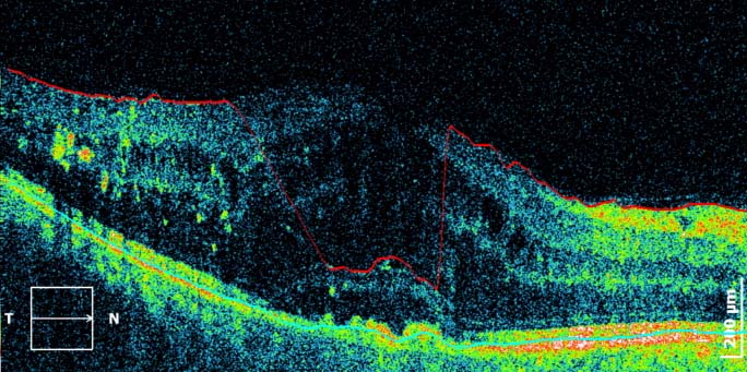 Djabetes komplikacije OCT edem makula