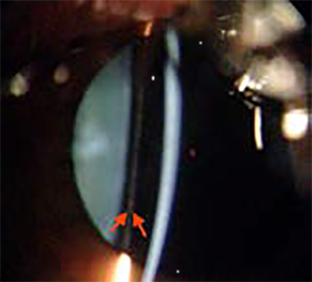 ICL CentraFLOW u oku