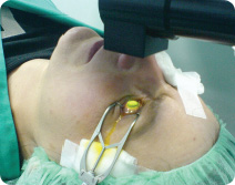 ultra B2 Cross-Linking