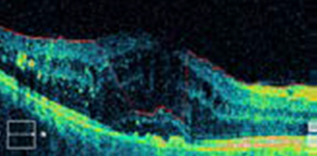 OCT - dijabetička makulopatija