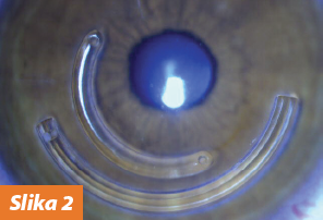 PRIMENA ULTRA B2 METODE