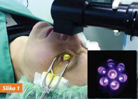 PRIMENA ULTRA B2 METODE