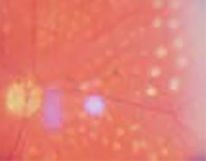 Sveži pečat posle LFK