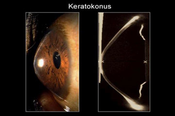 Video edukacija šta je keratokonus
